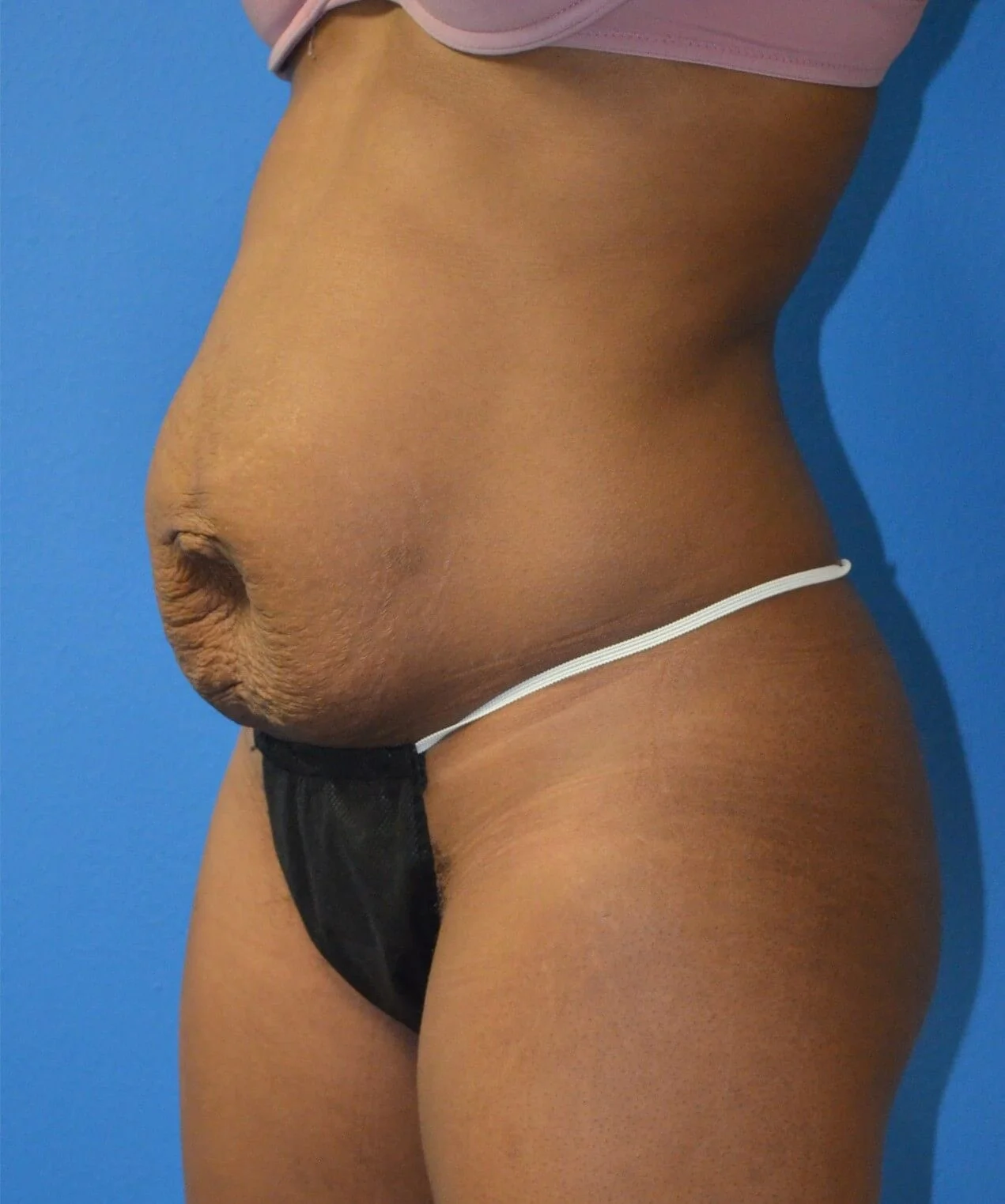 Tummy Tuck before — case 12, Austin TX