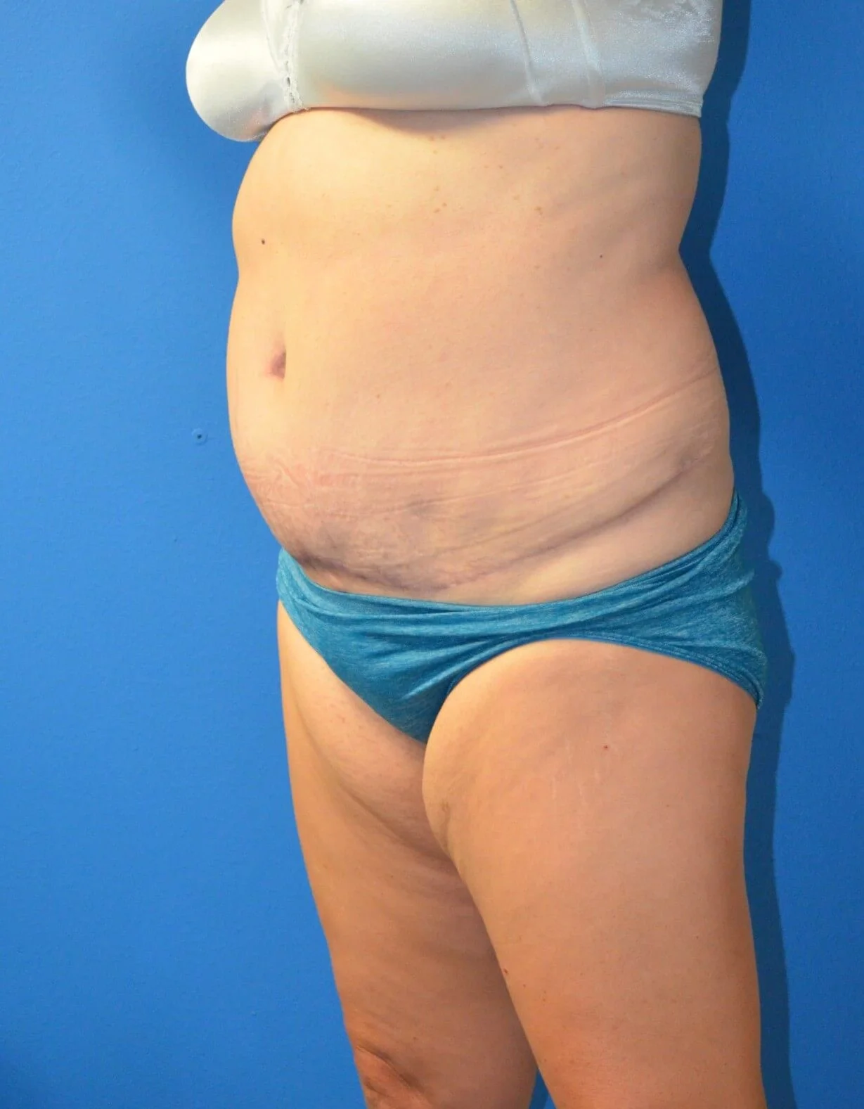 Tummy Tuck after — case 15, Austin TX
