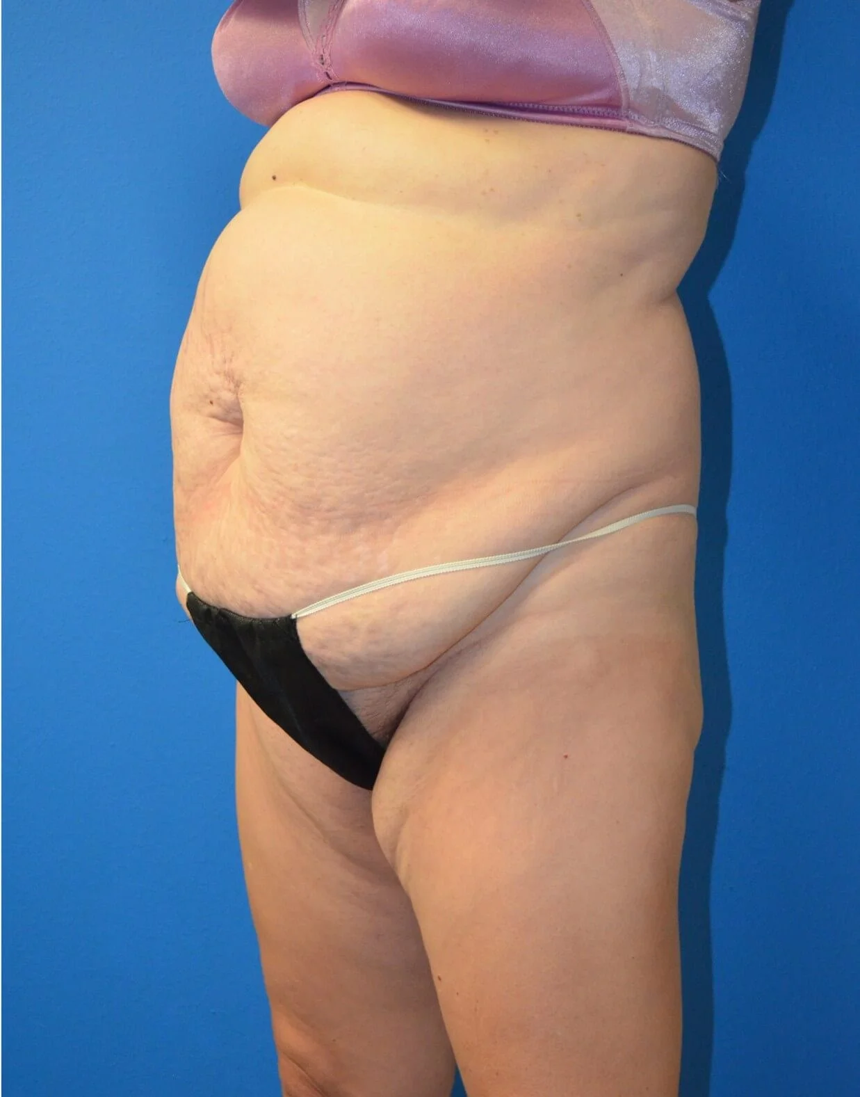 Tummy Tuck before — case 15, Austin TX