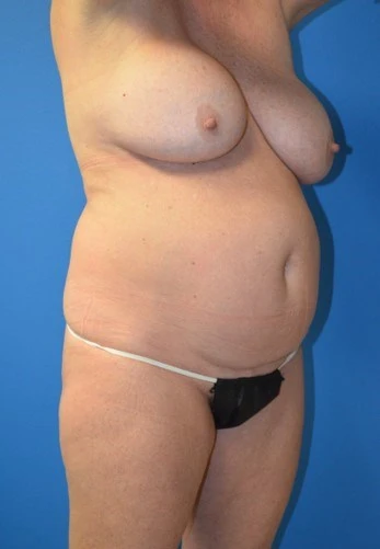 Tummy Tuck before — case 16, Austin TX
