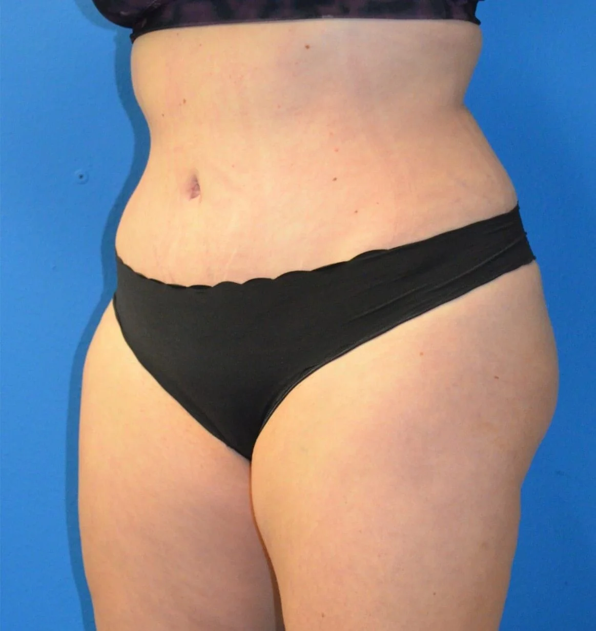 Tummy Tuck after — case 17, Austin TX