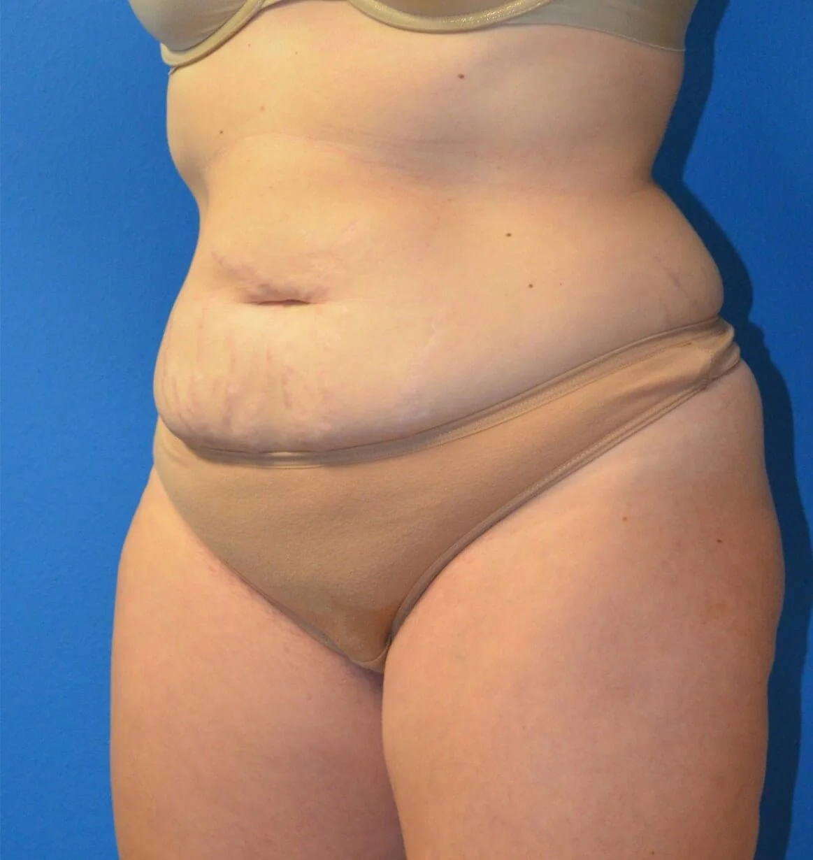 Tummy Tuck before — case 17, Austin TX
