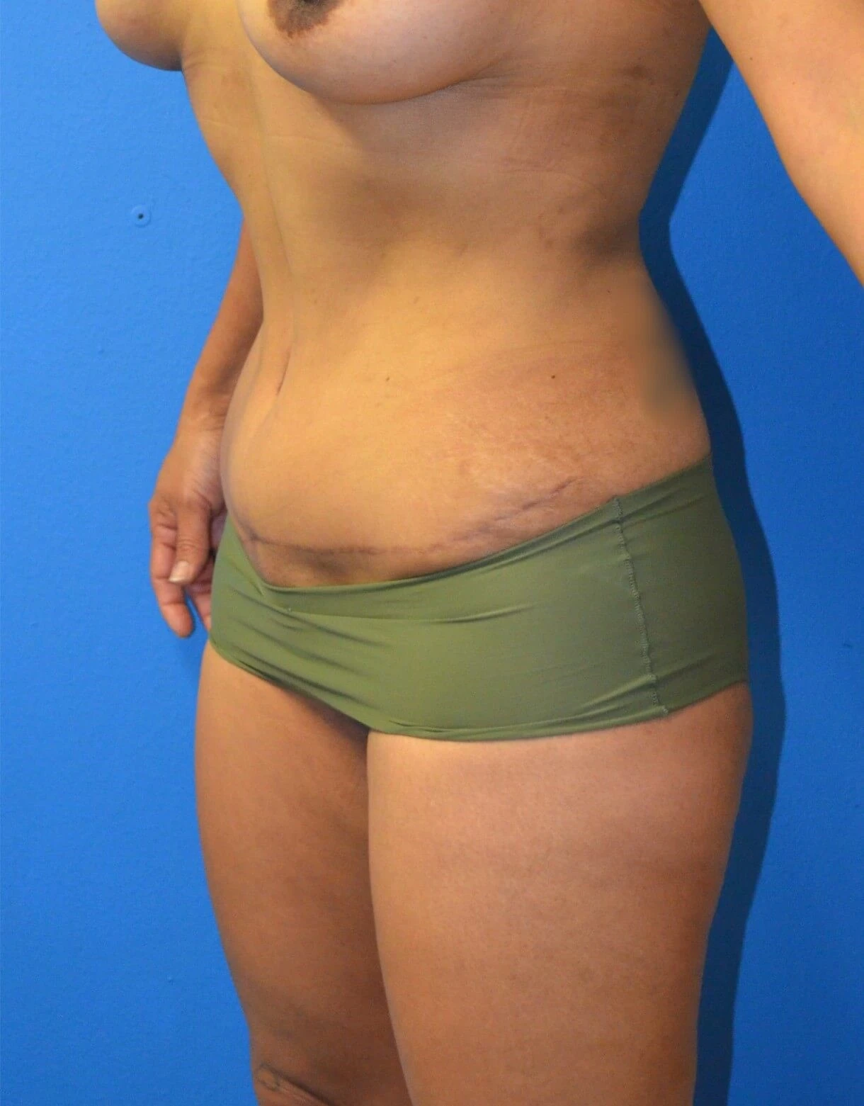 Tummy Tuck after — case 18, Austin TX