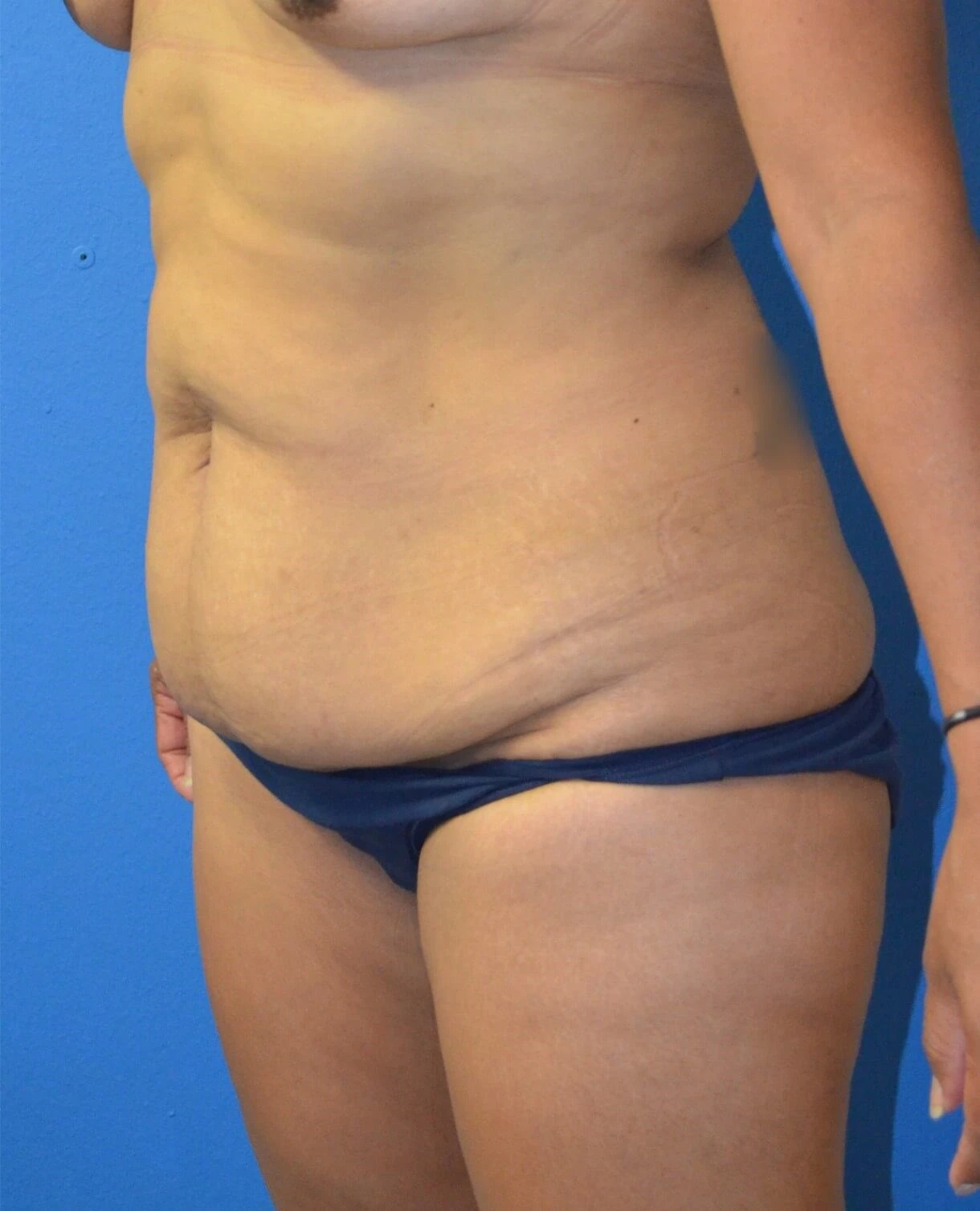 Tummy Tuck before — case 18, Austin TX