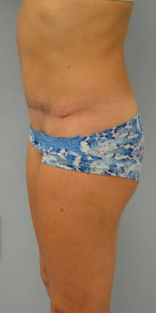 Tummy Tuck after — case 19, Austin TX