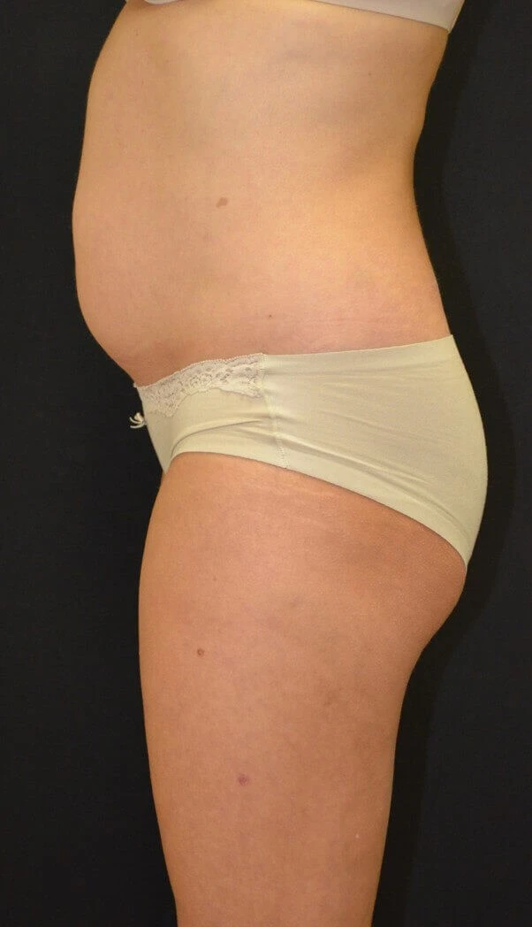 Tummy Tuck before — case 19, Austin TX