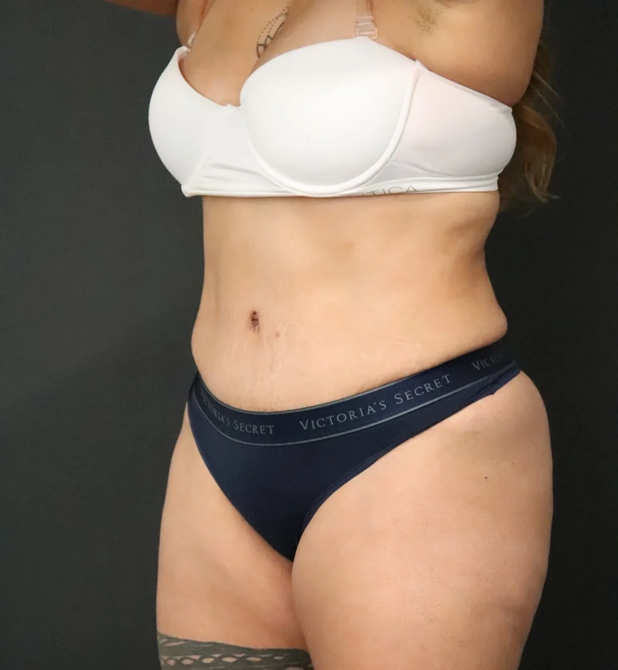 Tummy Tuck after — case 2, Austin TX