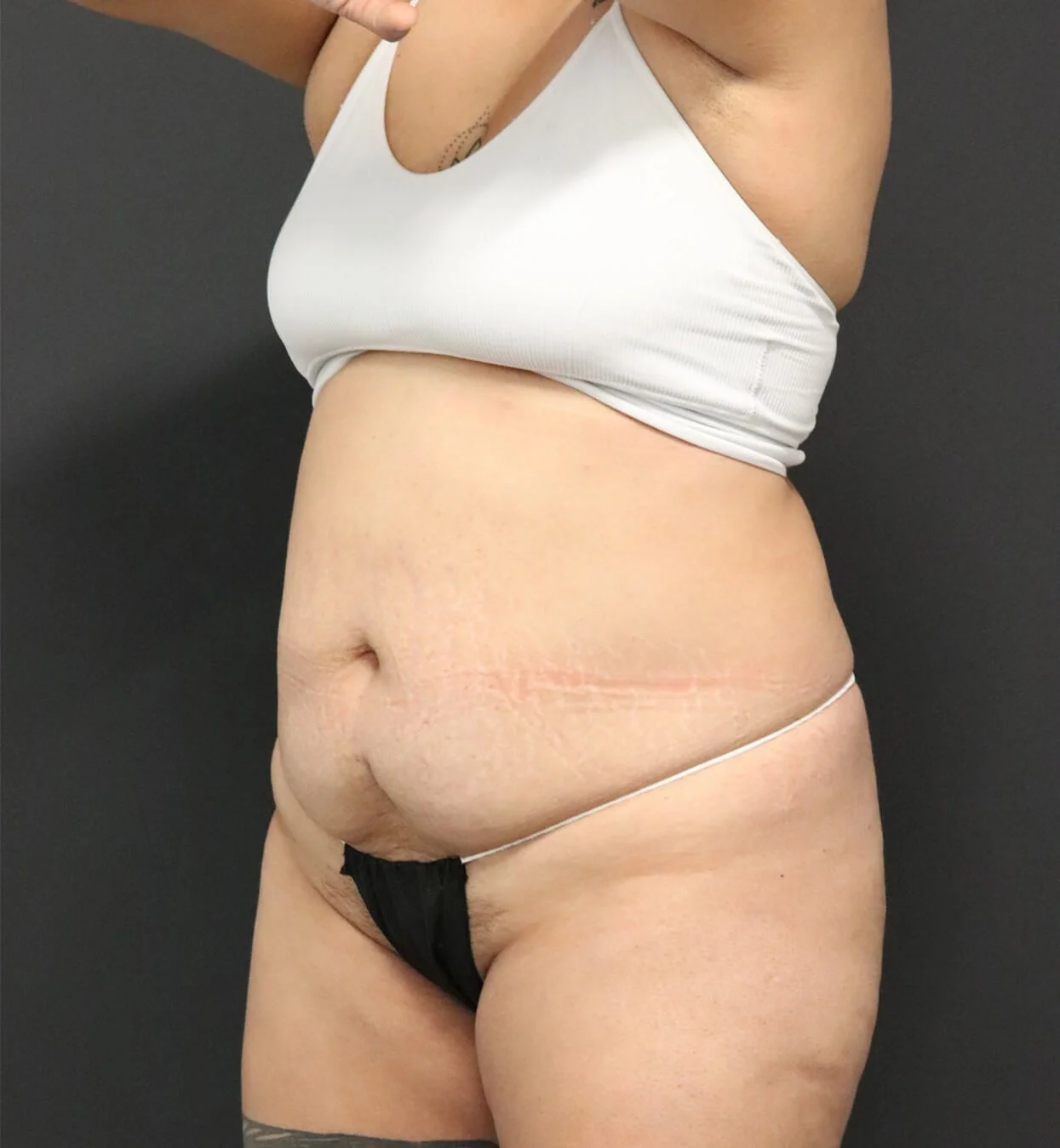 Tummy Tuck before — case 2, Austin TX