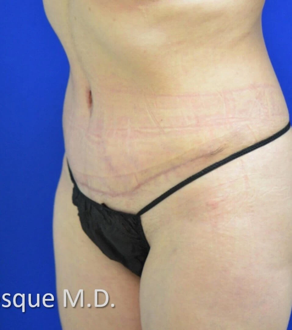 Tummy Tuck after — case 20, Austin TX