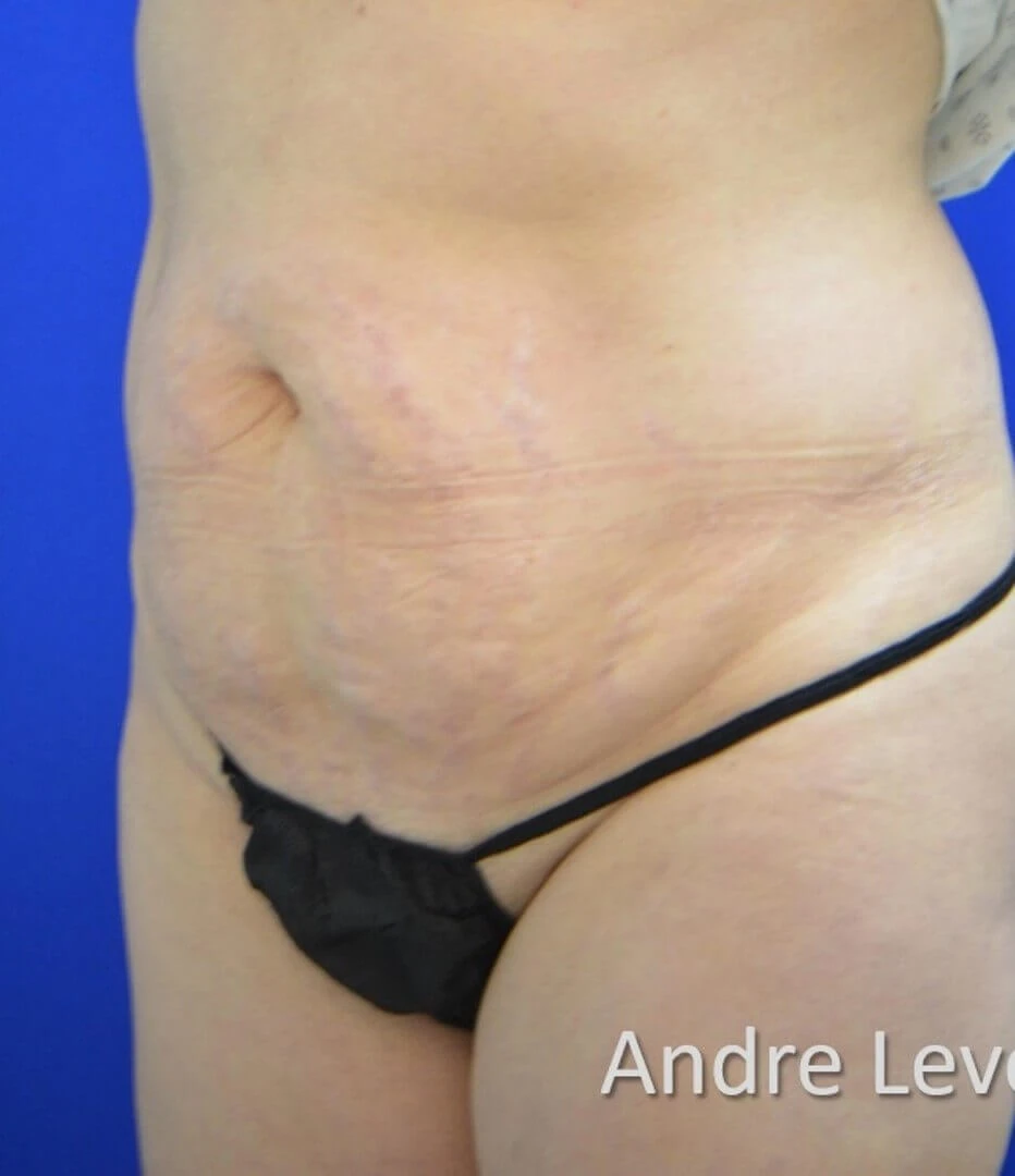 Tummy Tuck before — case 20, Austin TX