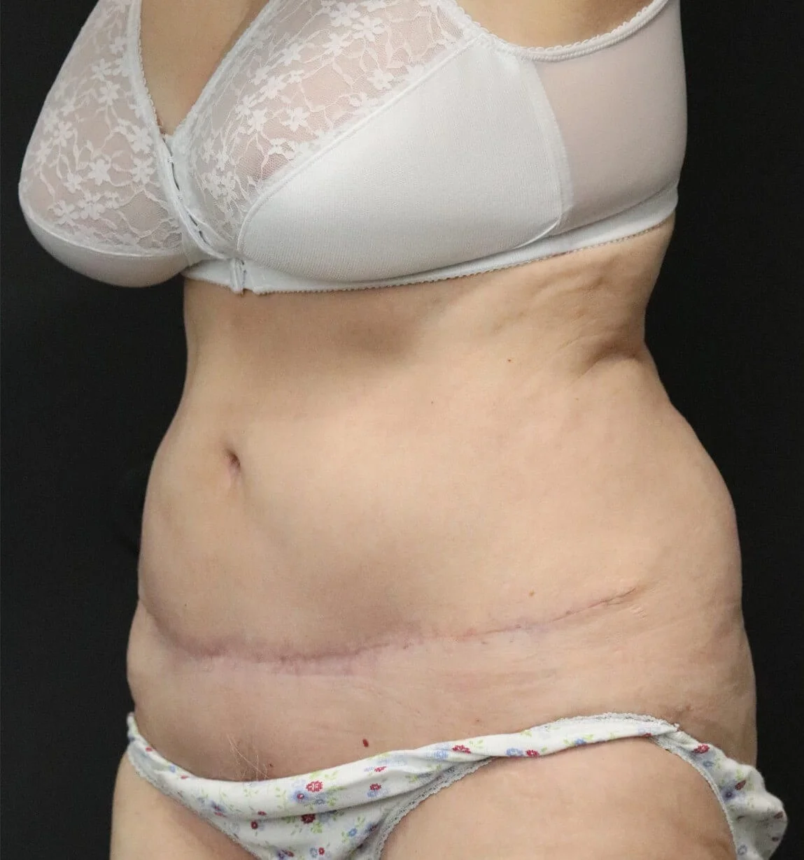 Tummy Tuck after — case 3, Austin TX