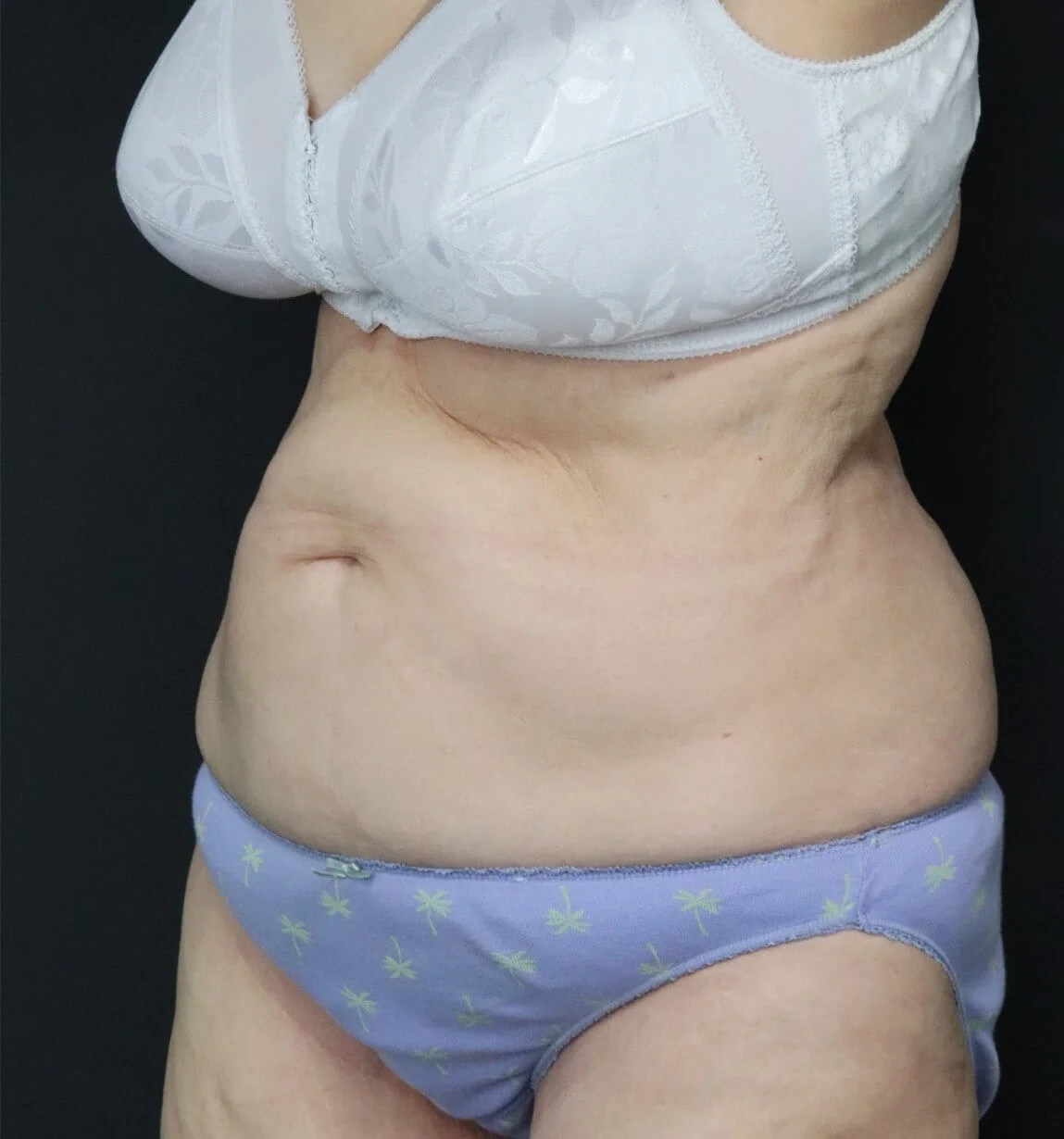 Tummy Tuck before — case 3, Austin TX