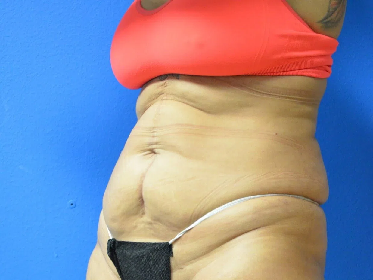 Tummy Tuck before — case 4, Austin TX