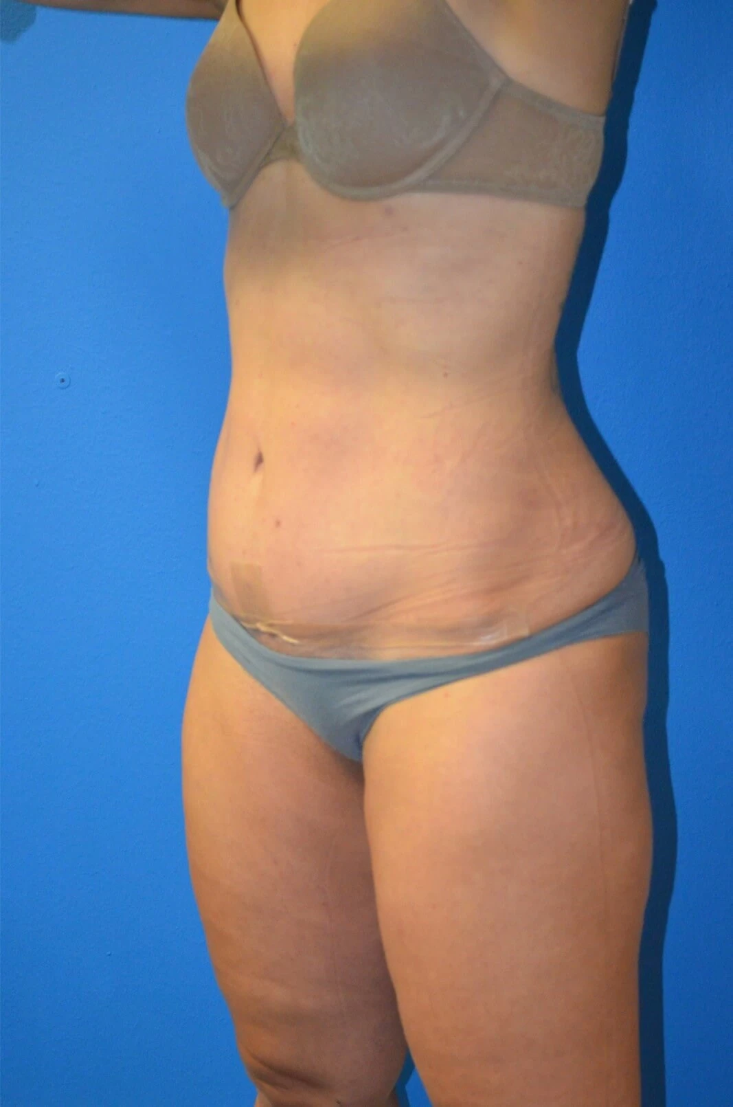 Tummy Tuck after — case 7, Austin TX
