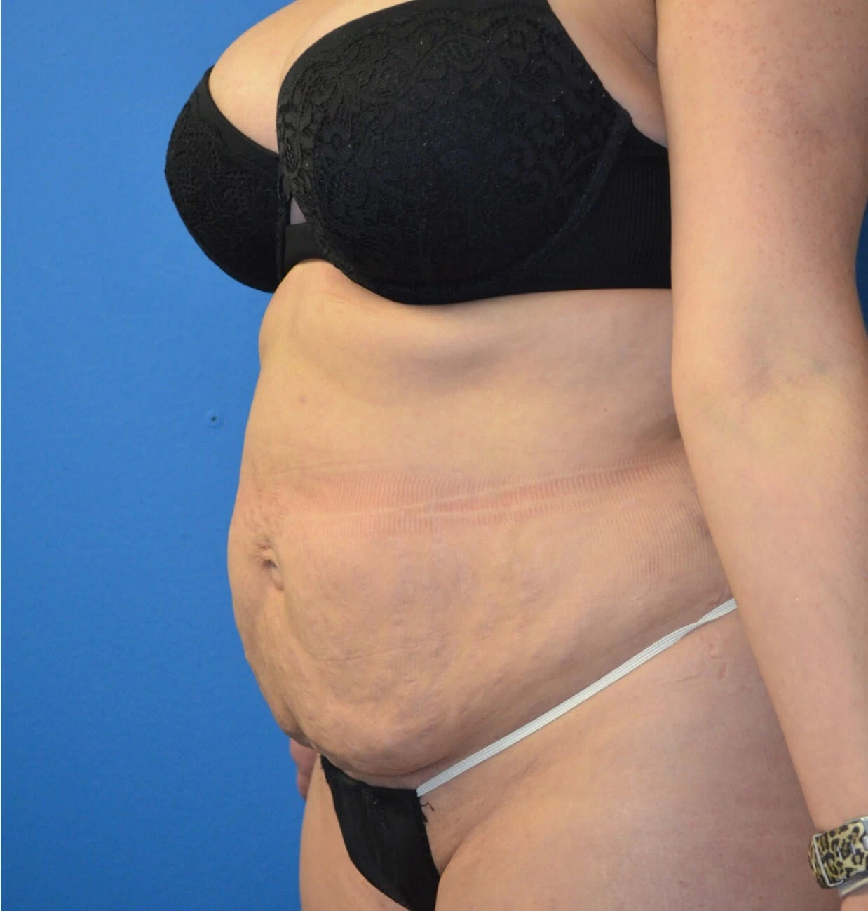 Tummy Tuck before — case 8, Austin TX