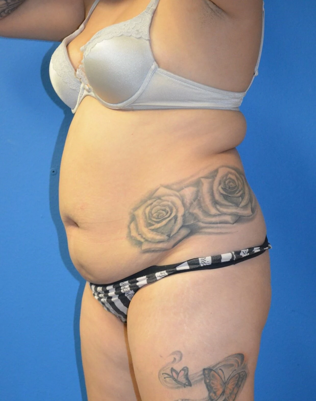 Tummy tuck — before, oblique view